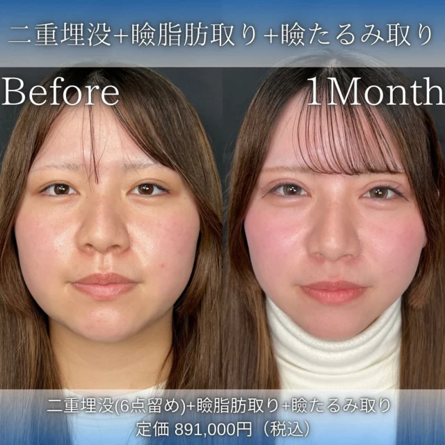 【二重埋没＋上瞼の脂肪取り＋瞼のたるみ取り】