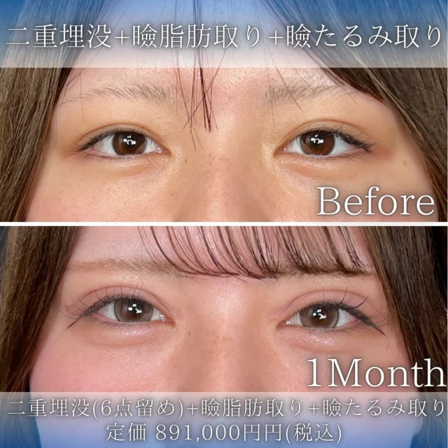 【二重埋没＋上瞼の脂肪取り＋瞼のたるみ取り】
