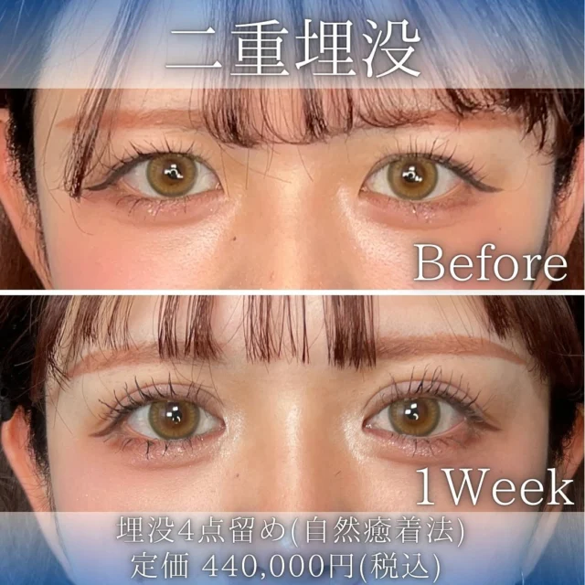 【二重埋没】