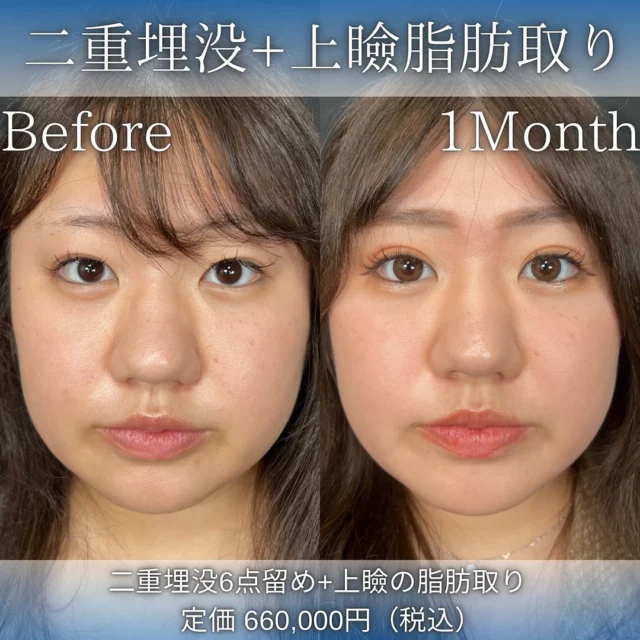 【二重埋没＋上瞼の脂肪取り】