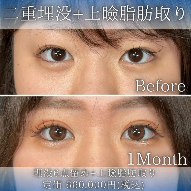 【二重埋没＋上瞼の脂肪取り】