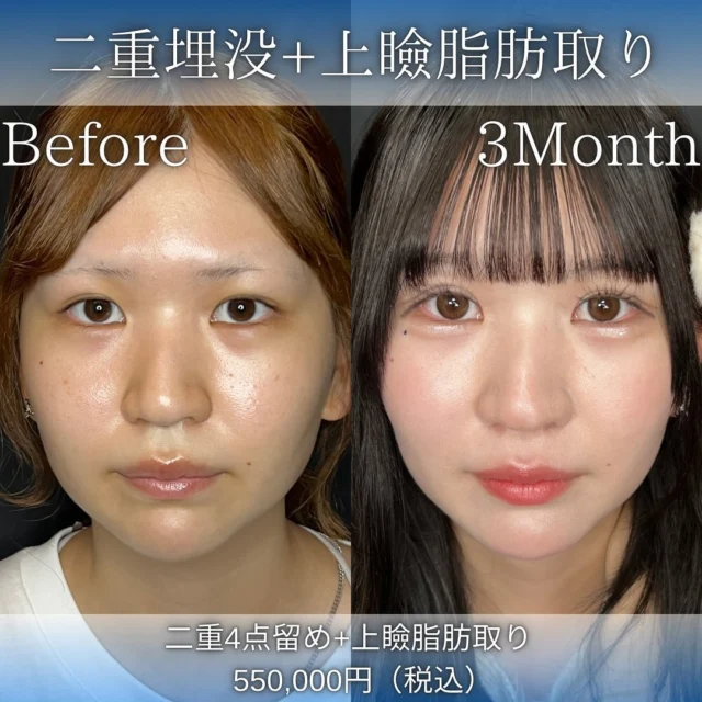 【上瞼の脂肪取り＋二重埋没】